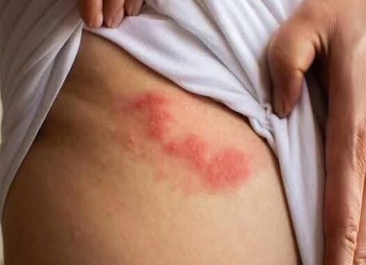 Cold sores: causes and recommendations Cold sores: causes and recommendations