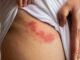 Cold sores: causes and recommendations