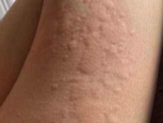 Her Whole Body Was Itchy: What She Thought Was a Common Allergy Was Hiding Something More Serious
