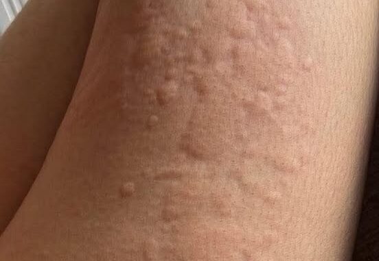 Her Whole Body Was Itchy: What She Thought Was a Common Allergy Was Hiding Something More Serious Her Whole Body Was Itchy: What She Thought Was a Common Allergy Was Hiding Something More Serious