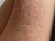 Her Whole Body Was Itchy: What She Thought Was a Common Allergy Was Hiding Something More Serious